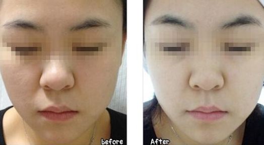 韓式微創(chuàng)無(wú)痕處女膜修復(fù)的效果如何？