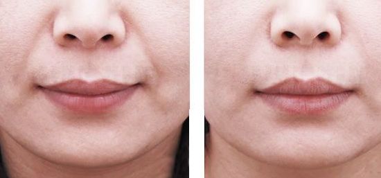 重慶藝星王永久醫(yī)生雙眼皮效果如何？90天招牌案例公開揭曉