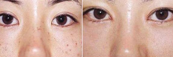 排名前五的廣醫(yī)二院雙眼皮醫(yī)生，價格參考2023