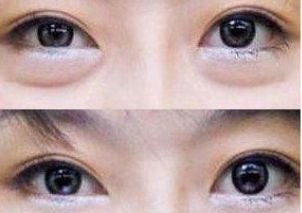 朝陽(yáng)區(qū)雙眼皮手術(shù)就找TA！專家力推朝陽(yáng)二醫(yī)院頂級(jí)雙眼皮醫(yī)生