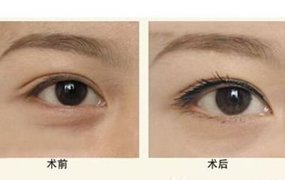 隆眉弓手術(shù)有哪些方法？如何成為隆眉保姆？