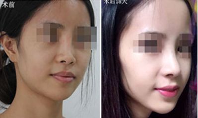 深圳哪家醫(yī)院隆胸效果好？排名前五火熱推薦！