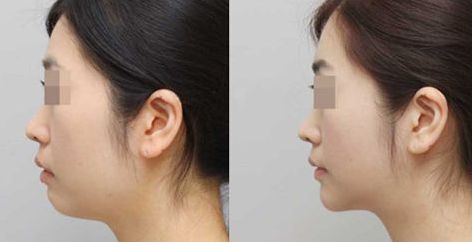 溫州優(yōu)質(zhì)修復(fù)整形醫(yī)院排行榜出爐！成就完美曲線，超高性價(jià)比驚艷推薦！