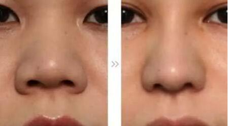 哪位醫(yī)生在全國范圍內(nèi)的脂肪填充領(lǐng)域技術(shù)比較好？