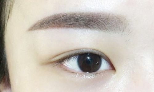 北京郭建玲雙眼皮手術(shù)費用是否昂貴？醫(yī)生案例分享全面解析