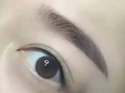 蘇州圣愛醫(yī)院整形科：90天變化揭示，雙眼皮驚喜盡顯！