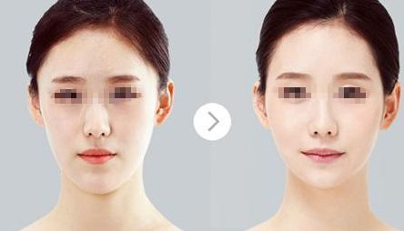 鄭州哪家醫(yī)院比較好做唇部整形？