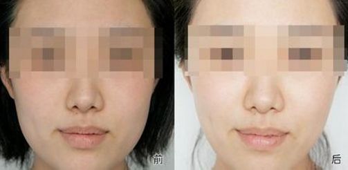 【揭秘】成都雙眼皮醫(yī)院最佳選擇，眼部微創(chuàng)手術秘訣大公開！