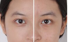 北京301醫(yī)院祛除眼袋方法揭秘，2023真實(shí)案例曝光！