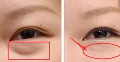 上海楊亞益雙眼皮修復(fù)技術(shù)解析，案例分享全文解讀
