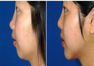 長春銘醫(yī)整形注射哪位醫(yī)師技術(shù)精湛？專家推薦與費用一覽