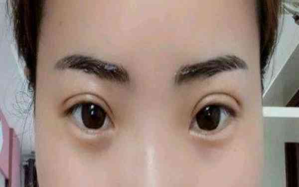 丁硯江填充脂肪的效果如何？為什么該方法備受推崇？