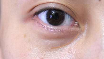 【重慶】銅雀臺雙眼皮醫(yī)生技術對比，伍森林、王杰醫(yī)、梁海彬誰更厲害？