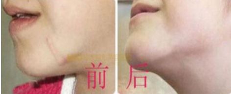 注射玻尿酸前需注意什么？用水清洗可否
