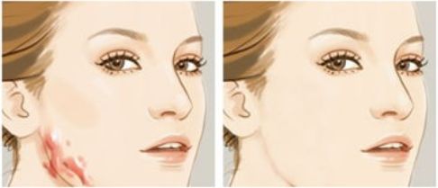 成都光子嫩膚的醫(yī)院選擇有哪些？推薦值得信賴的三甲公立機(jī)構(gòu)！