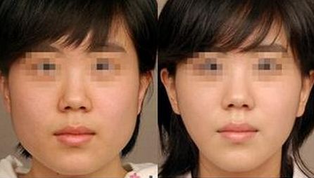 昆明自體脂肪填充專業(yè)醫(yī)院排行榜！獲取數(shù)量前十的醫(yī)療機構(gòu)名單！