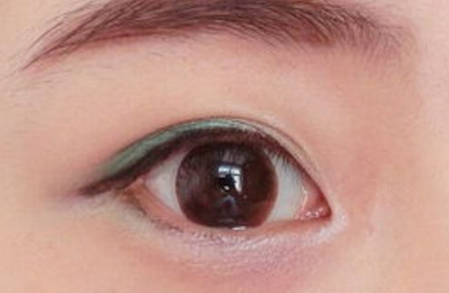 廣州高尚整形美容醫(yī)院隆鼻技術(shù)優(yōu)勢揭秘，80天細(xì)節(jié)圖曝光！