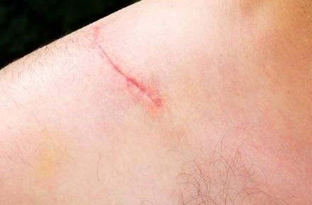八大處張超面部吸脂效果解析：醫(yī)生技術(shù)實力、案例與價格