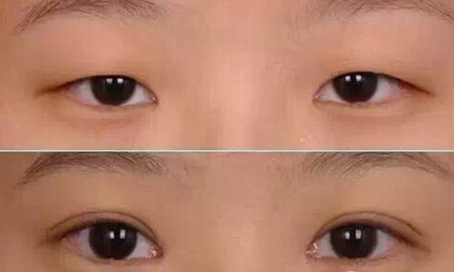 令人驚嘆！揭秘武漢華亞吳欣醫(yī)生的雙眼皮手術，身份資料披露！