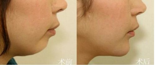 北京市前十名正頜醫(yī)院推薦：八處，協(xié)和，聯(lián)合麗格等，專業(yè)可靠！