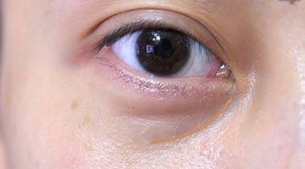 湘雅龍劍虹：雙眼皮案例解析及專(zhuān)業(yè)醫(yī)生簡(jiǎn)介