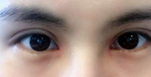 劉林奇：西南醫(yī)院墊下巴手術效果曝光！手術費用一覽表附近