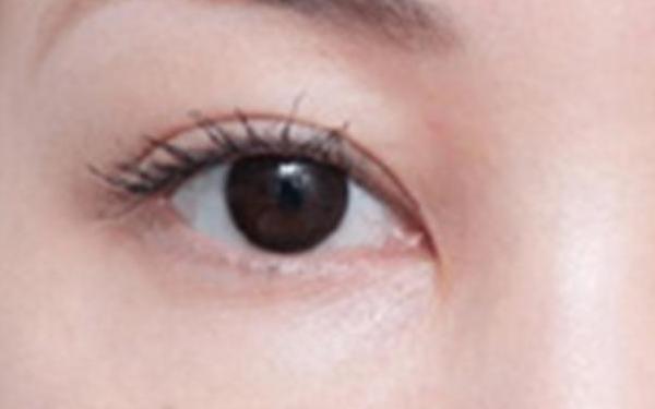 博愛醫(yī)院的雙眼皮效果如何？賈維順、許國明醫(yī)生資歷詳解