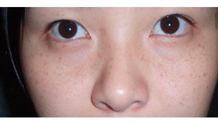 張恒術(shù)雙眼皮手術(shù)80天后效果揭曉，驚喜呈現(xiàn)！