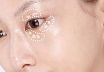 杭州葉秀娣做雙眼皮具體效果如何？專家實(shí)踐案例發(fā)布