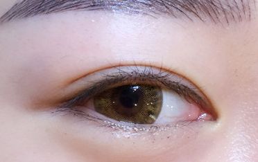 鄒翀，這一雙眼皮技術，近期有所革新