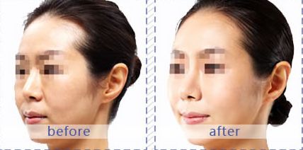 南京脂肪填充整形醫(yī)院推薦，蘇王、維多利亞和康美三家不容錯過的選擇