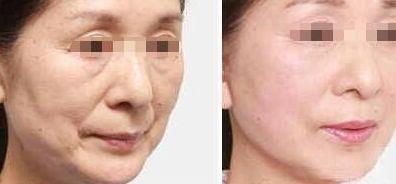 寧波頂級醫(yī)院去眼袋的價格及經(jīng)驗(yàn)分享