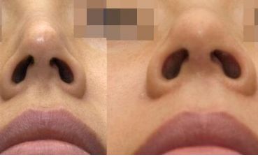 南寧整形醫(yī)院治療疤痕效果如何？最佳選擇揭秘