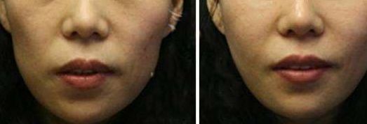 洛陽市第三人民醫(yī)院整形科雙眼皮效果如何？2023真實案例分享