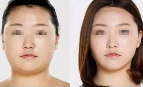 寧波2023年抽脂醫(yī)生排名揭曉！這幾位口碑爆棚的專家堪稱翹楚！
