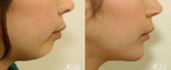 廣州哪些整形醫(yī)院效果好？排名前十的吸脂醫(yī)院有哪些？