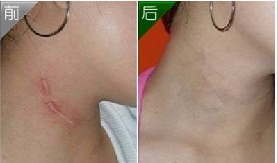 廣州隆胸手術(shù)費(fèi)用及案例分享，口碑如何？