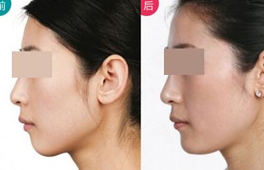 上海哪個醫(yī)生擅長鼻翼縮??？2023年度網(wǎng)民口碑推薦醫(yī)生名冊曝光