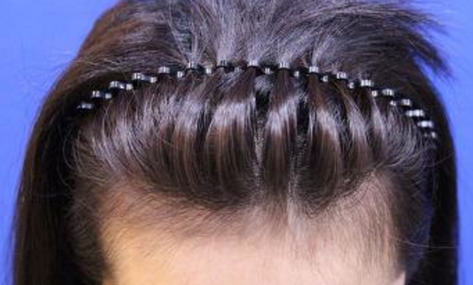 雙眼皮手術(shù)如何才能達(dá)到自然效果？需要注意哪些飲食禁忌？