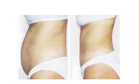 寧波哪家醫(yī)院的拉皮手術(shù)技術(shù)值得信賴？值得關(guān)注的醫(yī)院排行榜推薦