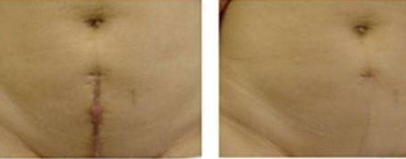 重慶張恒術(shù)進(jìn)行雙眼皮手術(shù)，醫(yī)生實力以及成功案例展示