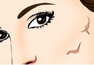 張曉建拉皮的效果好不好？如何評價？