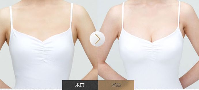 全面了解雙眼皮手術(shù)，揭秘風(fēng)險與安全