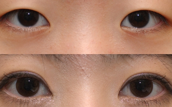 上海哪家醫(yī)院做眼袋手術(shù)價(jià)格實(shí)惠又靠譜？排行榜前十強(qiáng)！