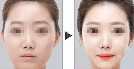 石家莊最受歡迎的除皺美容醫(yī)院排名榜前六來襲！2023年超贊抗衰除皺全攻略！