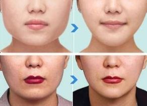 杭州哪家醫(yī)院做下頜角整形效果好？綜合口碑、價(jià)格受好評(píng)的幾家醫(yī)院推薦
