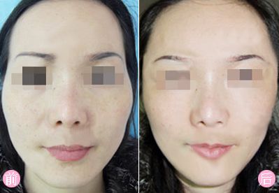 寧波開展熱瑪吉除皺整形的權(quán)威醫(yī)院推薦，絕對值得信賴！