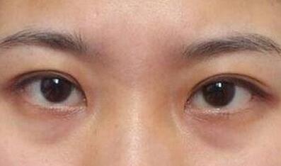 杭州東方整形吸脂到底值不值得嘗試？