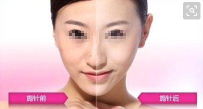廣州哪家醫(yī)院可以安全進(jìn)行拉皮手術(shù)？