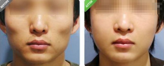 深圳哪家醫(yī)院的拉皮除皺效果最好？排名前幾位的醫(yī)院有哪些？